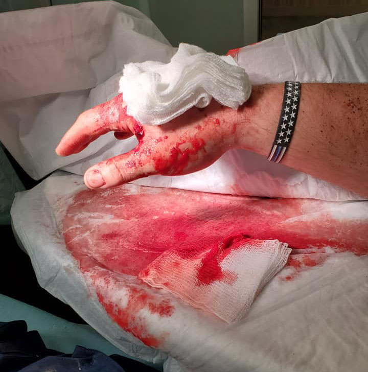 Bloody Hand with Bandage on Top