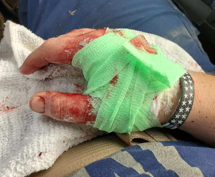 Bandaged Bloody Hand